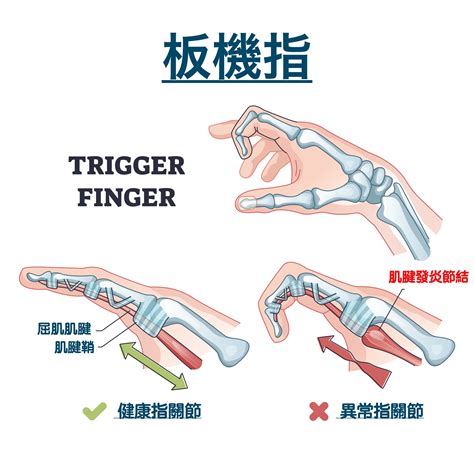 為什麼手指會歪歪的|手指彎曲就伸不直？板機指介紹：疾病成因、症狀、簡略處理方法。